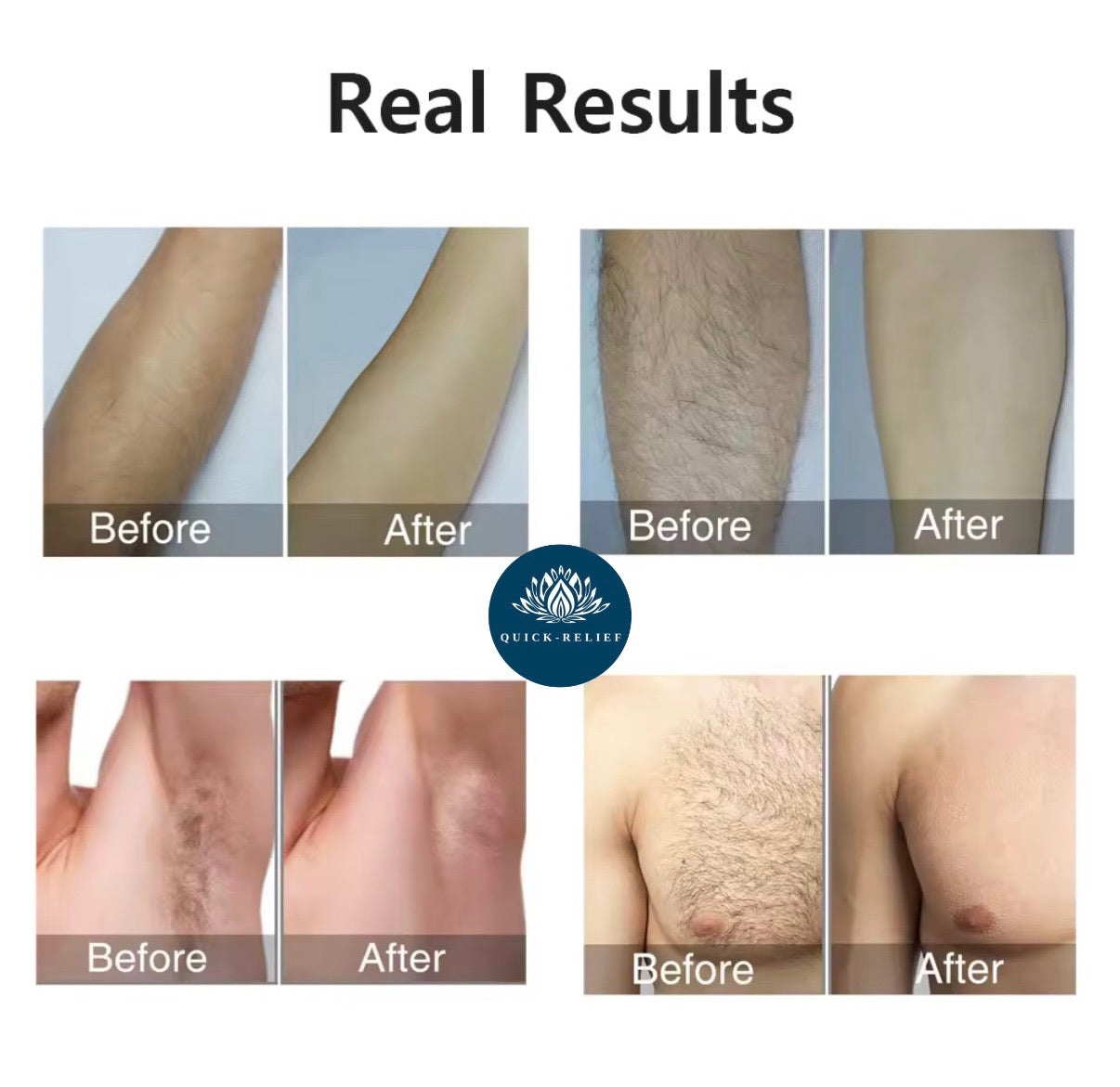 IPL Hair Removal Device